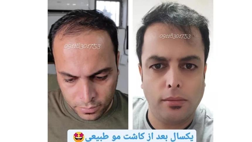 بهترین کلینیک کاشت مو در گلسار رشت