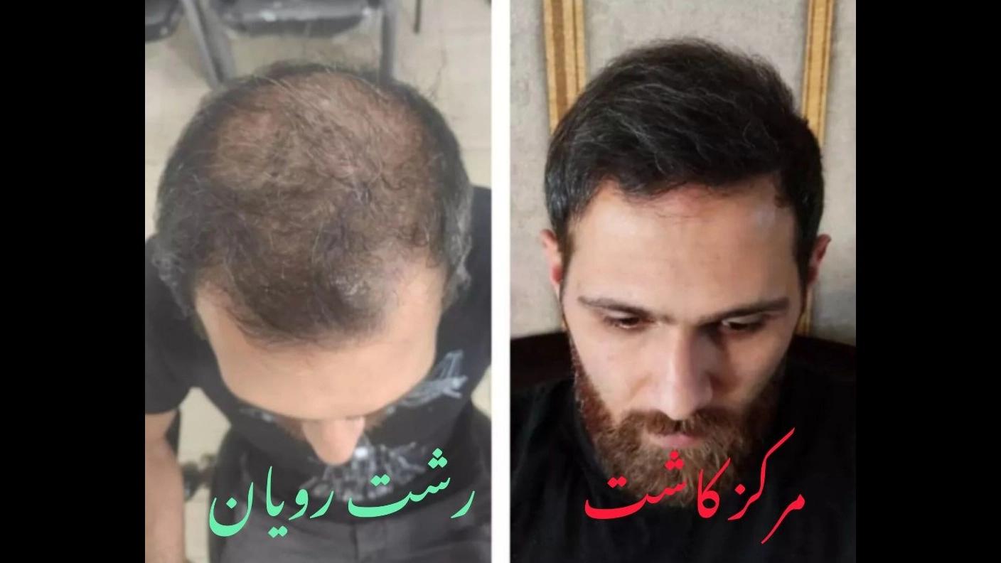 کاشت مو اقساطی در رشت؛ شرایط پرداخت و هزینه کاشت مو