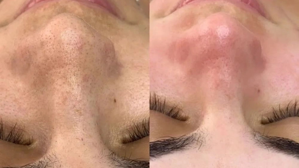پاکسازی عمیق پوست و رفع لک در مشهد